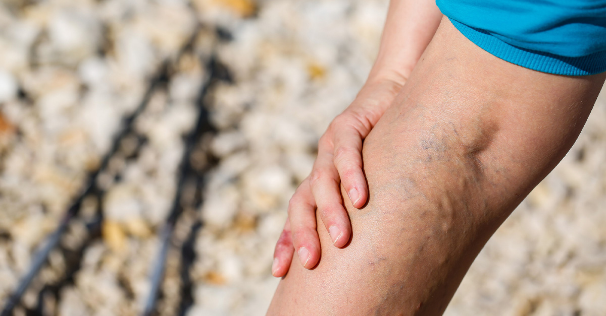 Varicose veins showing up on the back of a person's leg.