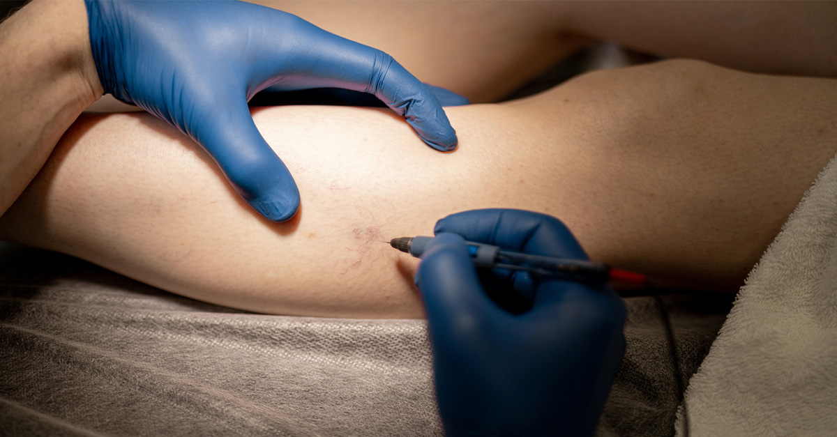 Sclerotherapy being performed on a woman’s leg.